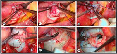 Expanding Valve Repair in Rheumatic Heart Disease